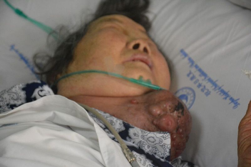 可谁能想象,一个重达两三斤的巨型肿瘤二十多年挂在脖子上是什么感受?