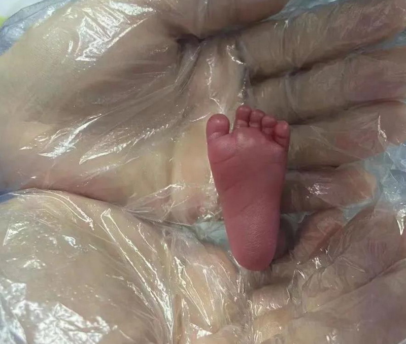  出生体重仅为1120g和920g！达州超早产双胎“巴掌宝宝”顺利出院