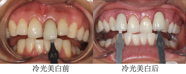 郑州哪家牙齿美白最好 - 健康资讯 - 达州日报网